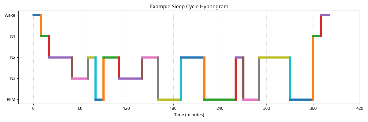 Hypnogram showing normal sleep cycles with NREM and REM periods across the night.